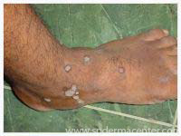 Warts Before