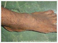 Warts After