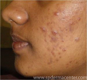 How to Treat Hyperpigmentation in Skin of Color