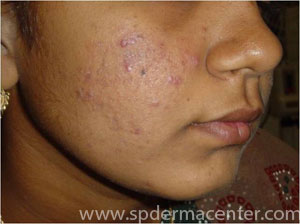 Acne IPL-Before