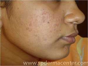 Acne IPL-After