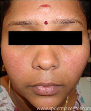 Rosacea IPL-After