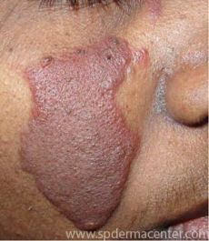 Hemangioma