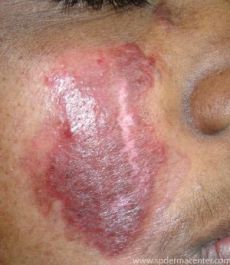 Hemangioma Treated