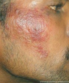 Hemangioma treated