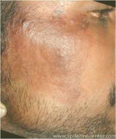 Hemangioma After