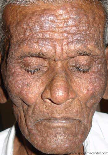 Chronic Actinic Dermatitis-Before