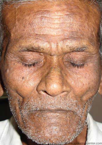 Chronic Actinic Dermatitis-Treated