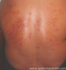 Cutaneous Larva Migrans-Before