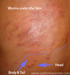 Cutaneous Larva Migrans-treated