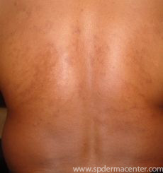 Cutaneous Larva Migrans-After