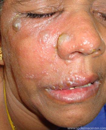 Herpes-Zoster-Before