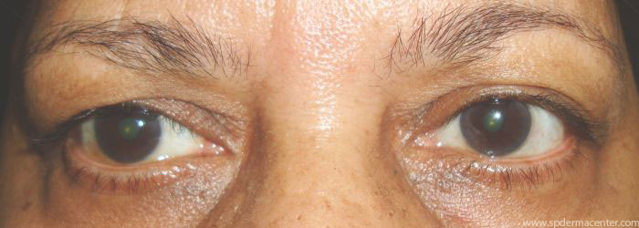 Blepharoplasty