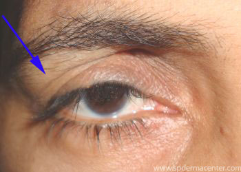 Blepharoplasty