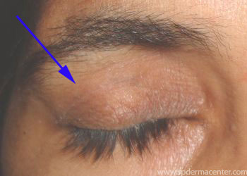 Blepharoplasty