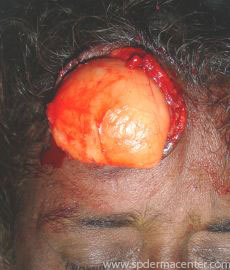 Cutaneous Larva Migrans-treated