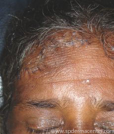 Cutaneous Larva Migrans-After