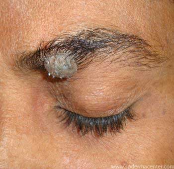 Herpes-Zoster-Before