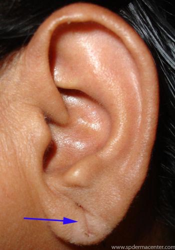 Ear-Lobe-Treated